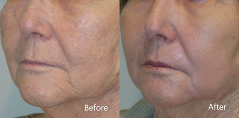 Uporaba frakcioniranega CO2 laserja za pomlajevanje obraza - odpravljanja pigmentiranih sprememb na koži obraza, žilnih struktur in zmanjšanja videza gub