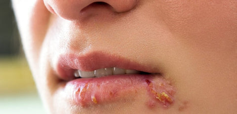 V redkih primerih lahko po laserskem zdravljenju predelov kože na obrazu pride do reaktivacije okužbe s herpes simplex virusom