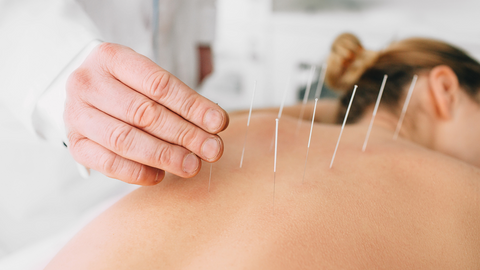 blaženje simptomov luskavice z akupunkturo, alternativna metoda 