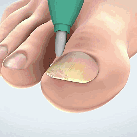 Lucovital® - Pisalo za glivice na nohtih