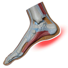 Plantar Faciitis xray