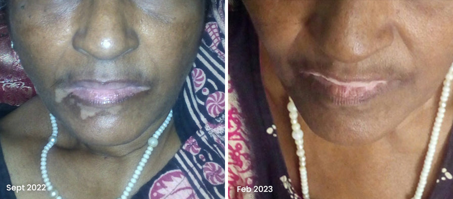 Vitiligo Organics Real Results Before After