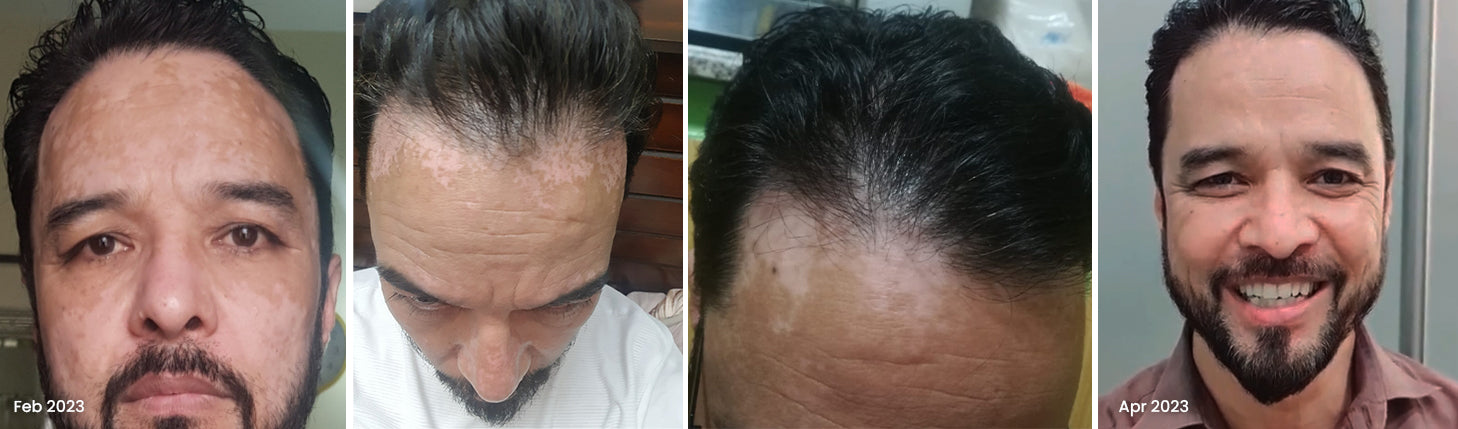 Vitiligo Organics Real Results Before After