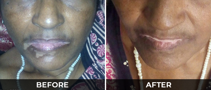 Vitiligo Real Results Before After