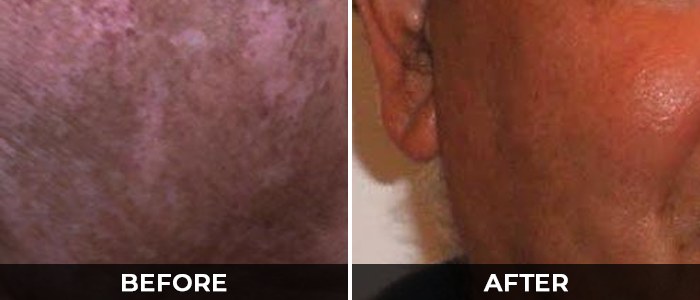 Vitiligo Real Results Before After