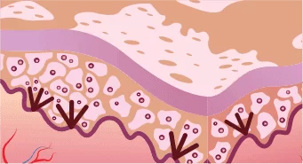 Stage 2 Small dots of original skin colour start to appear