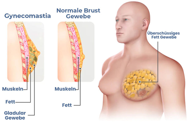Oveallgo™ Gynäkomastie Z Muskelaufbau Kompressions-Tank-Top