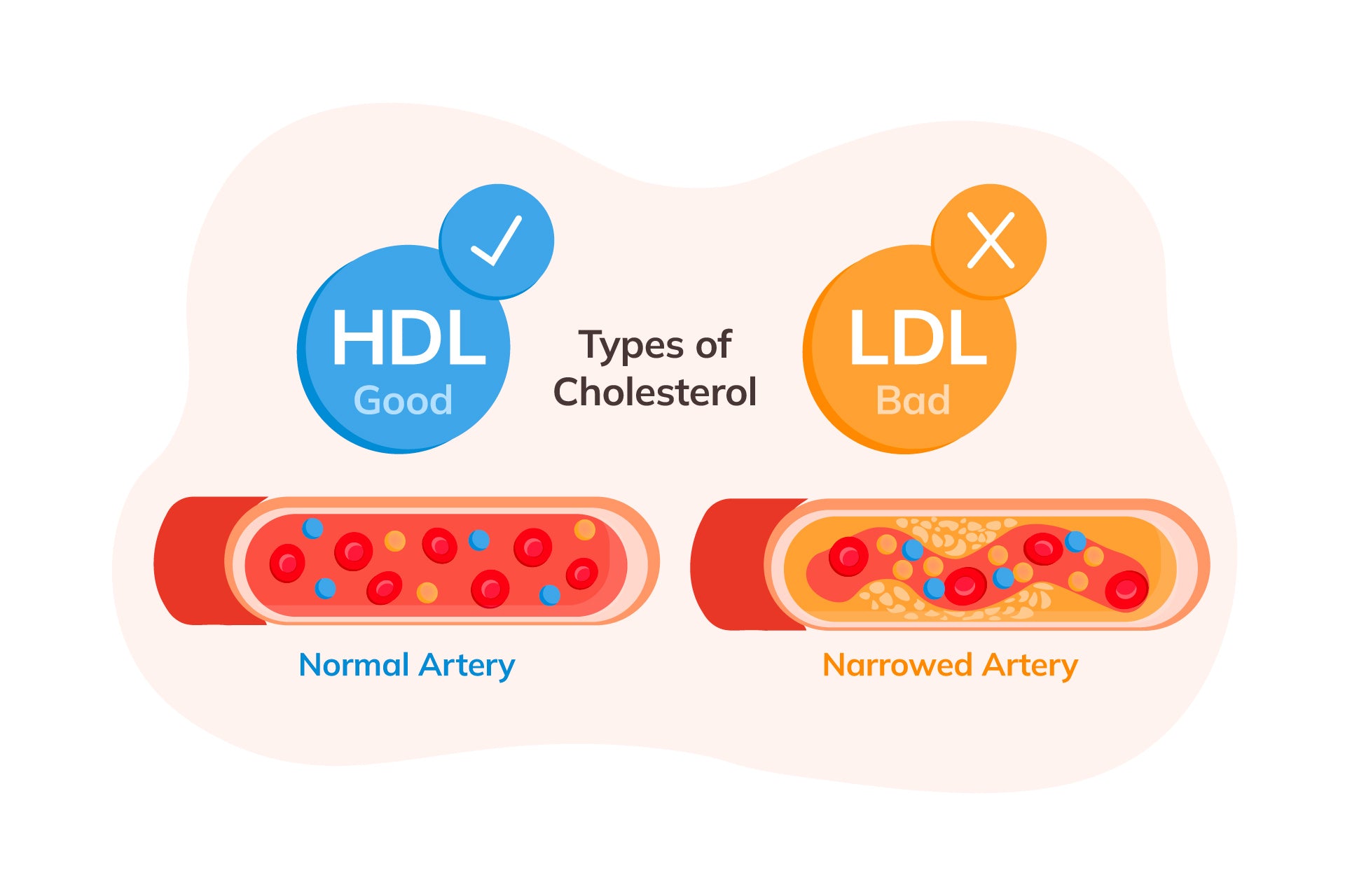 cholesterol-hdl-ldl.jpg__PID:6f02e09a-4dfb-410f-8b0f-63c00fb52587