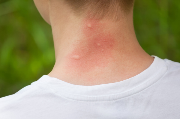 Person with red mosquito bites on back of neck