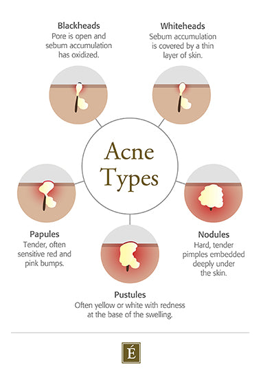 acne types