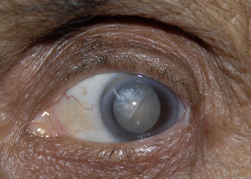 Advanced Cataract