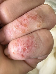 contact dermatitis from lanolin allergy