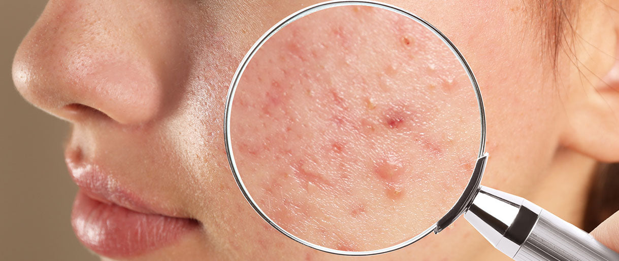 The Science Behind Acne