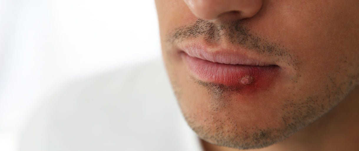 Understanding Herpes