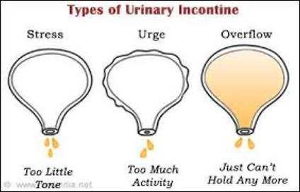 Types Of Urninary Incontine