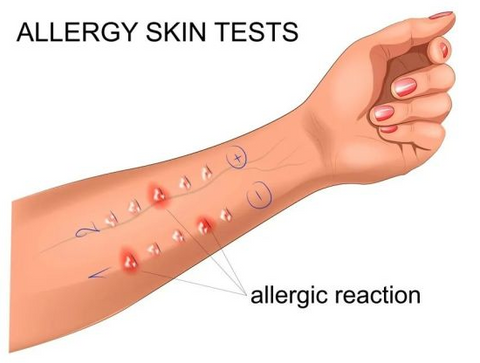 Allergy skin tests