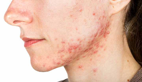 Cyst acne