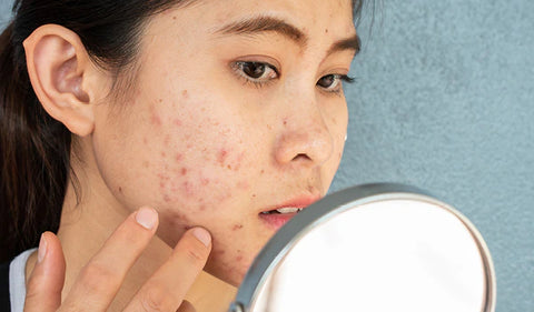 Nodular Acne