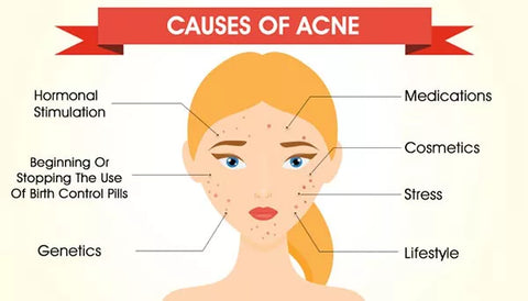 causes of acne