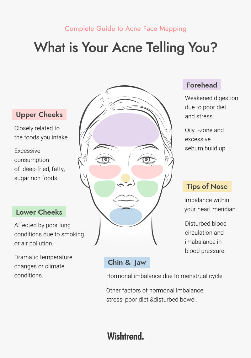 acne diagram of the face