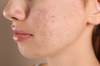 Decoding Acne: Is it Hormonal or Bacterial?