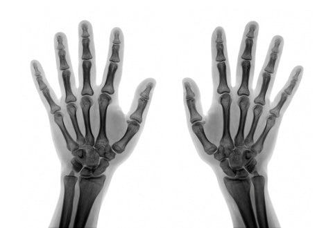 Phalanx Hand osteoarthritis
