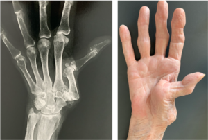 rhizarthrosis arthrosis thumb
