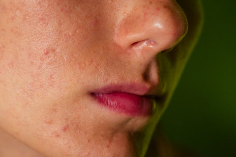 Acne prone skin