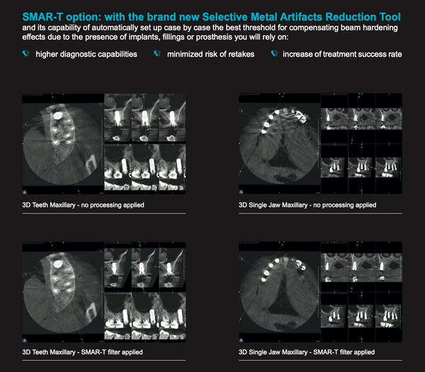 SMAR-T option: with the brand new Selective Metal Artifacts Reduction Tool