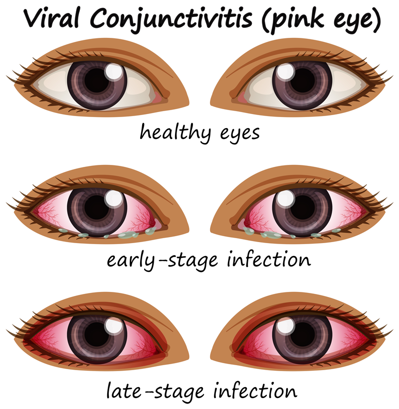 tired-eyes-infection-viral-conjunctivitis-pink-eye