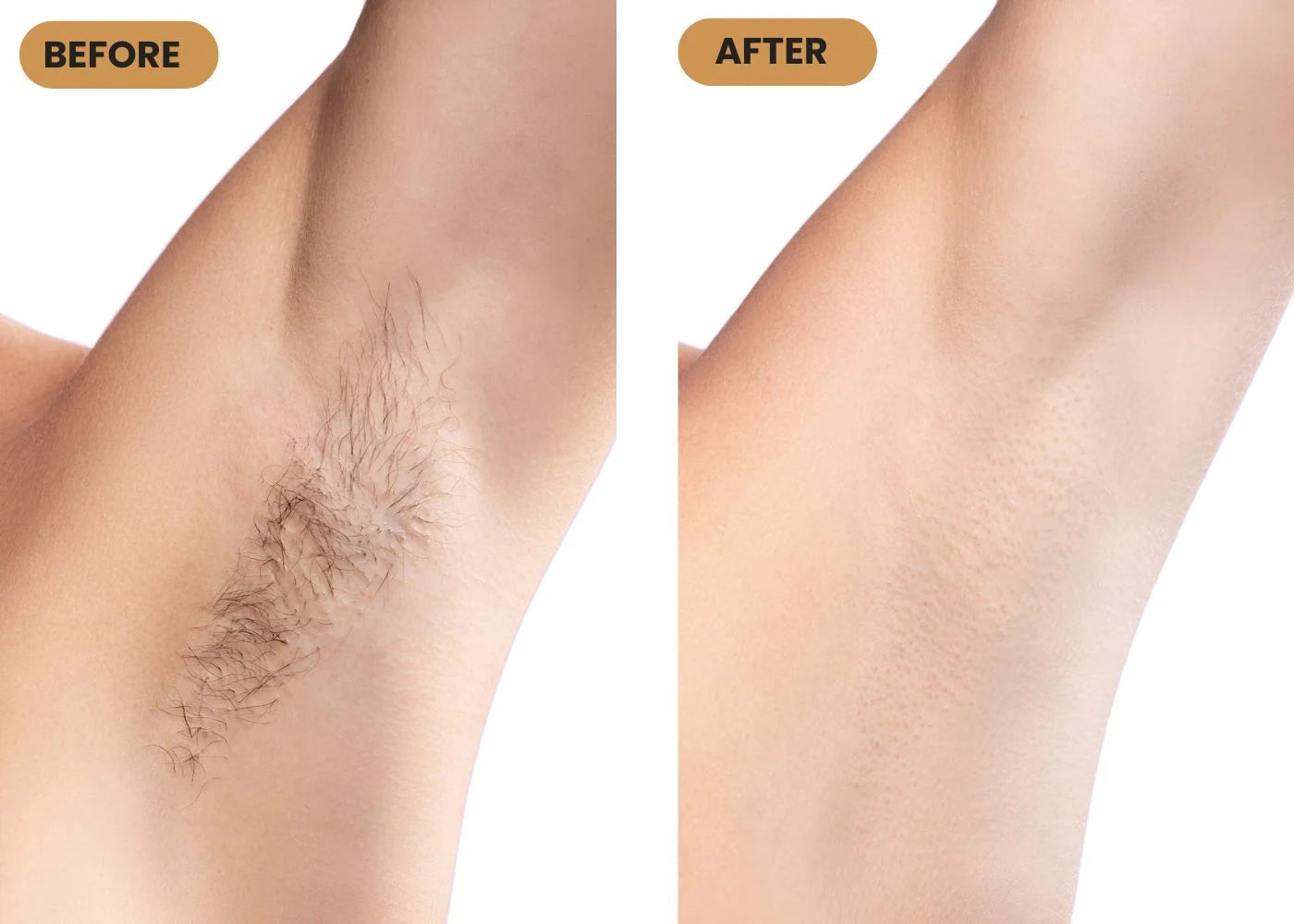 At-home IPL Hair Removal