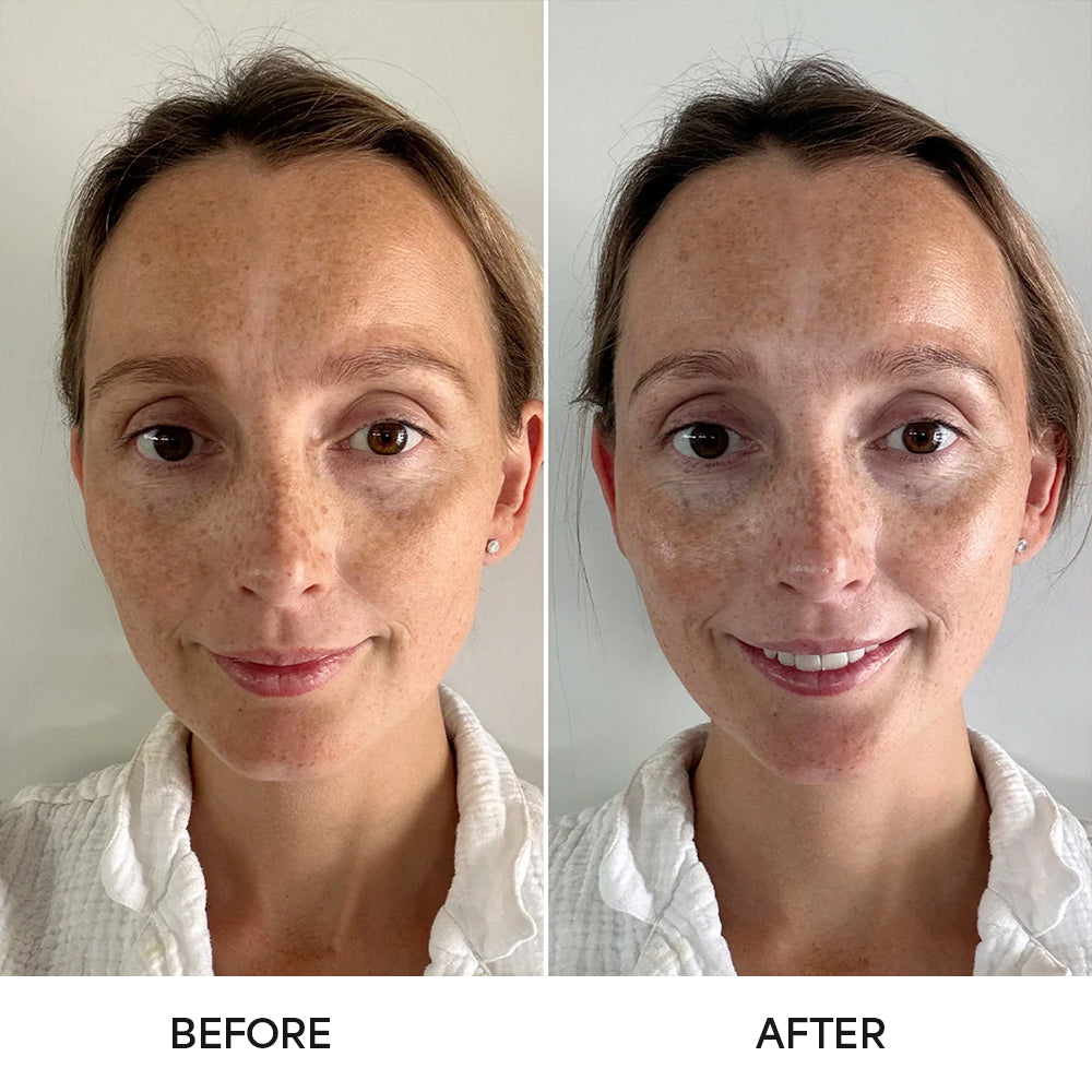 Two-panel before and after photo of a woman showing skin improvement.