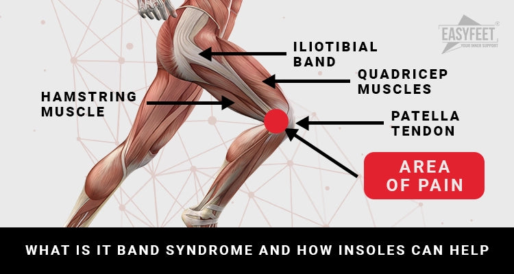 Iliotibial band syndrome: What causes it?
