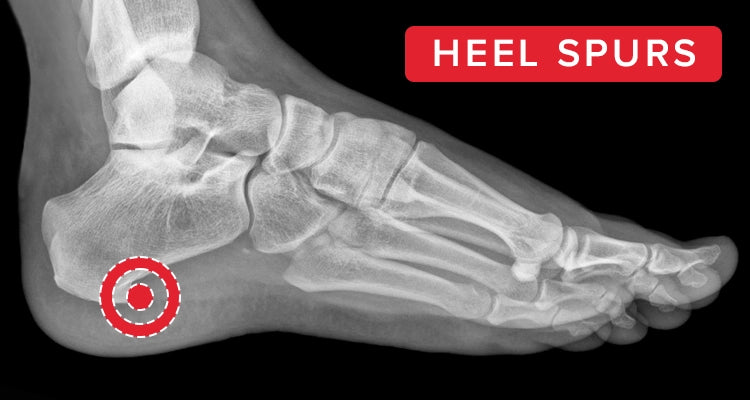 heel spur surgery