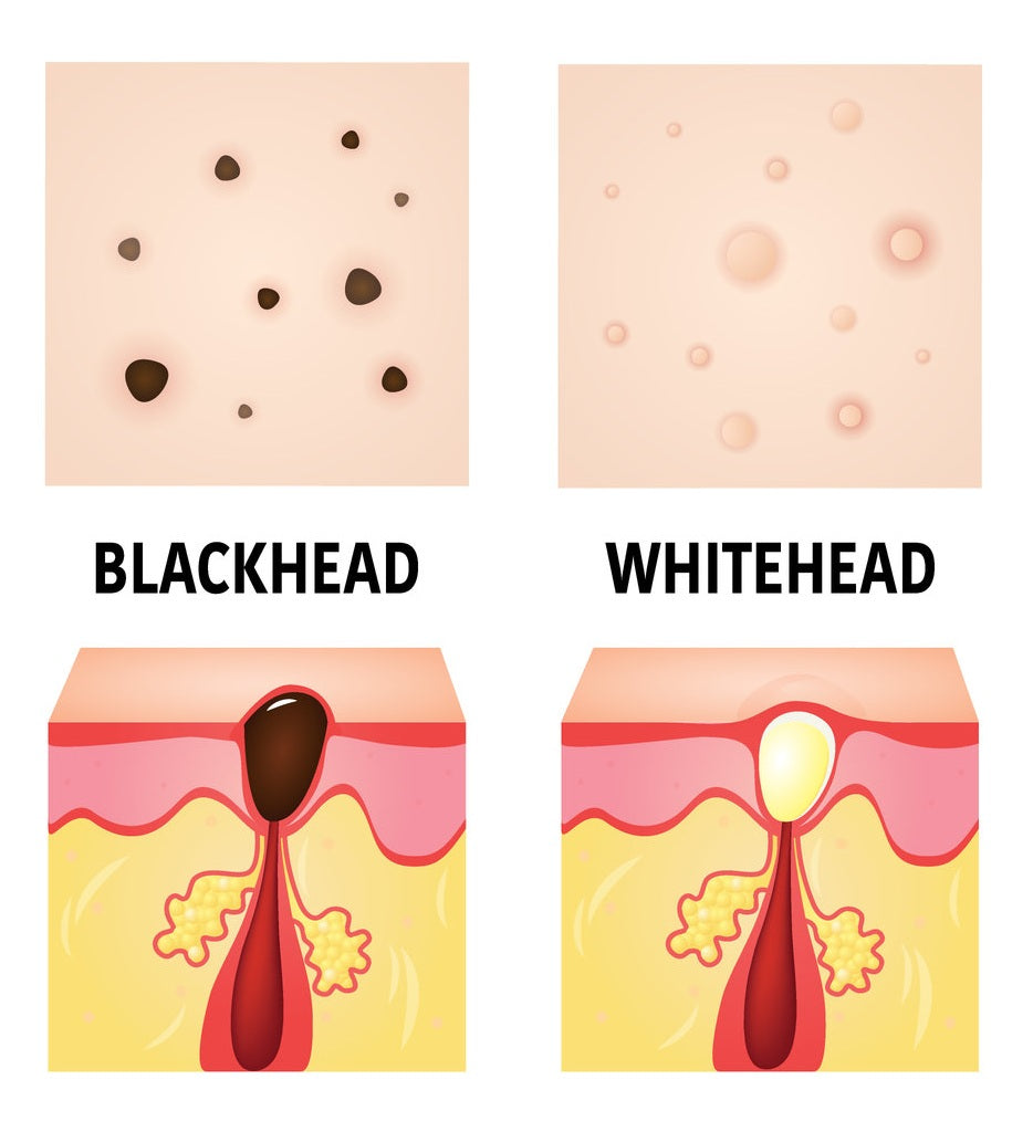 Blackheads