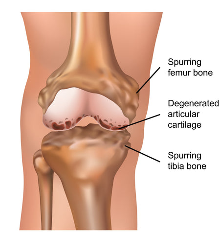 Osteoarthritis results in bone rubbing on bone and formation of bone spurs