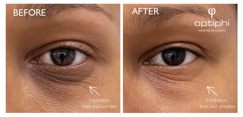 Visible anti-aging results with optiphi Eye Signs
