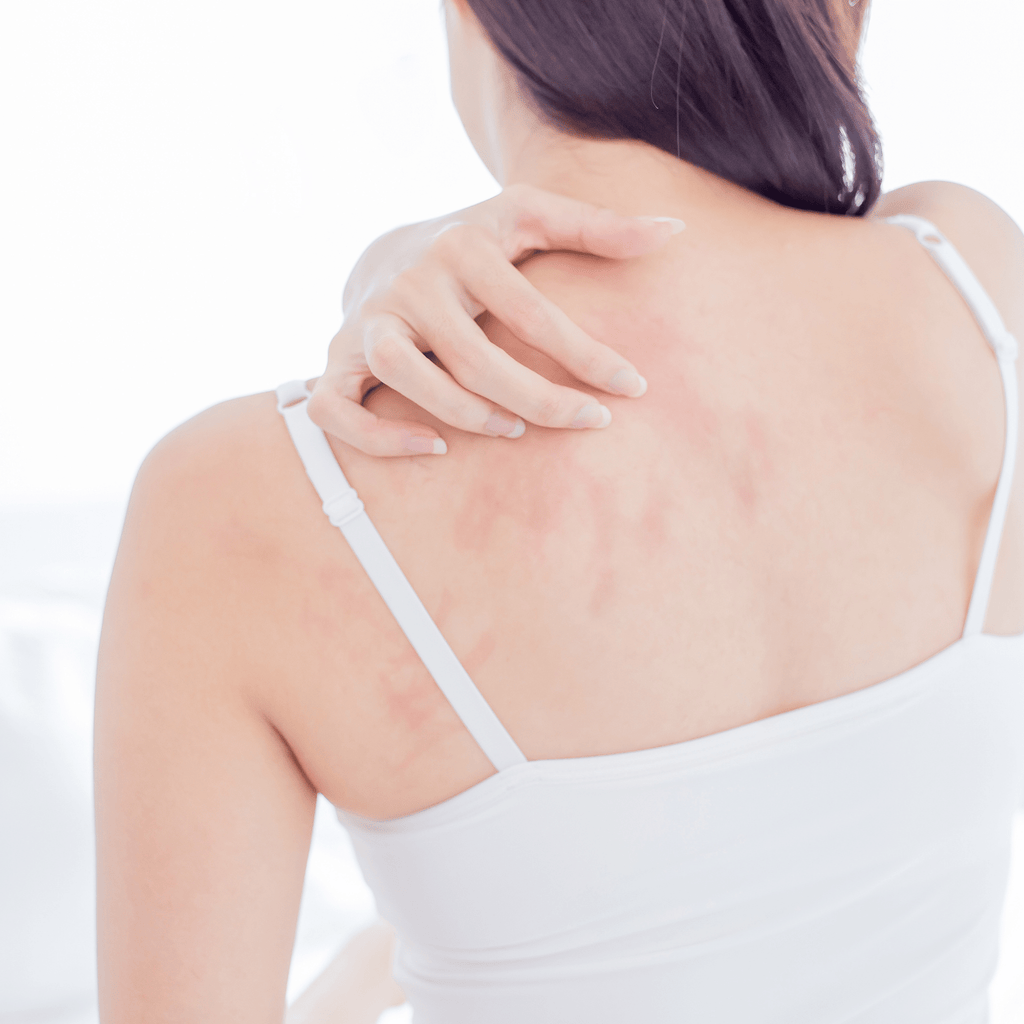 Itchy Skin In Winter - How To Treat Dry Skin Itch
