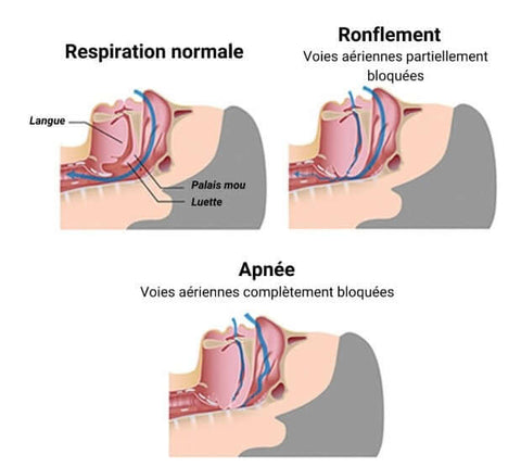 Apnée du sommeil