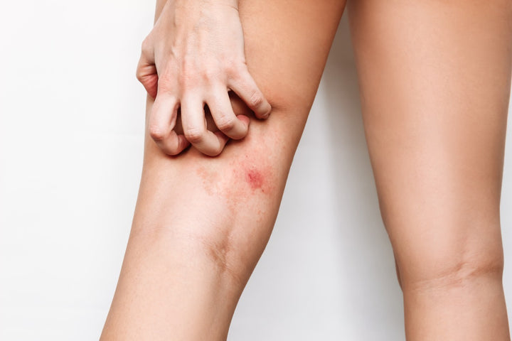 Everything You Need to Know About Inner Thigh Chafing