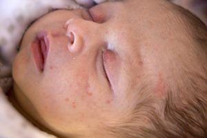 newborn rash