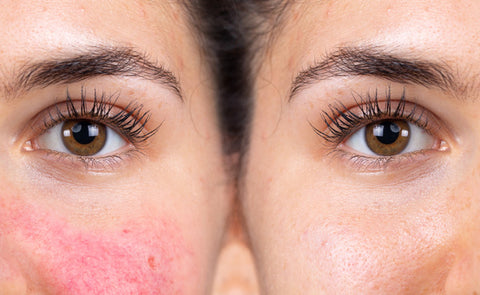 Woman With And Without Rosacea