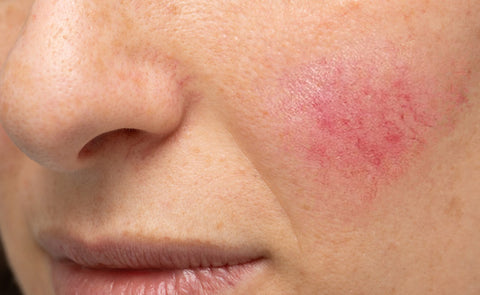  Woman With Rosacea