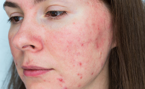 Woman With Rosacea