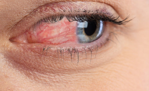 Rosacea In The Eyes