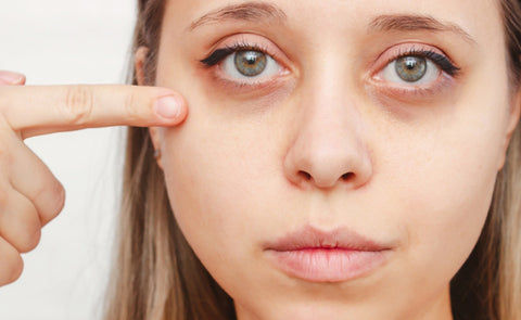  Woman Pointing At Her Dark Circles