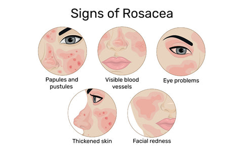 Rosacea Symptoms
