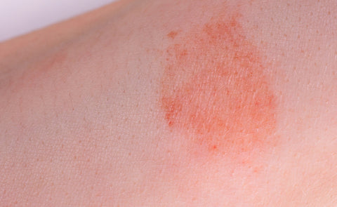 Red Spots On Skin
