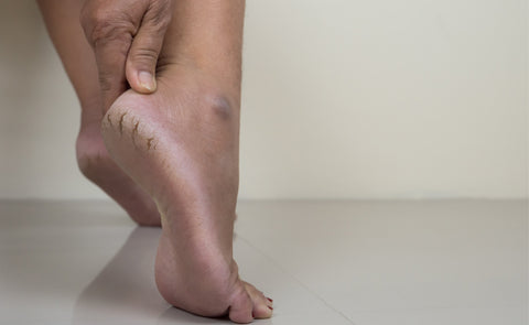 Moisturize to Help Heal Dry Cracked Heels | Vaseline®