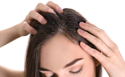 woman with dandruff in oily hair